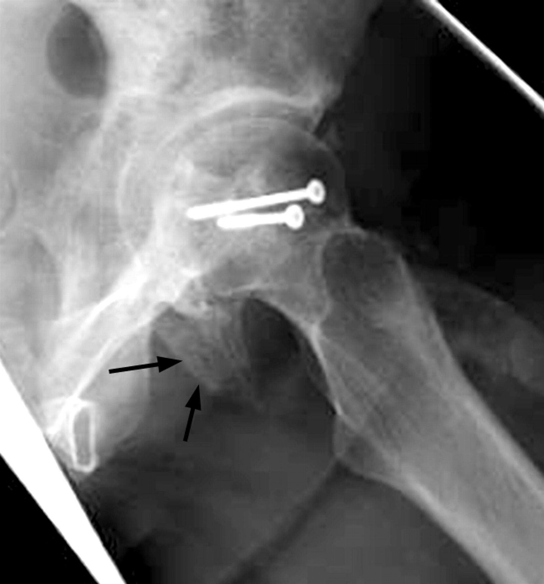 Femoral Head Fractures Trauma Orthobullets